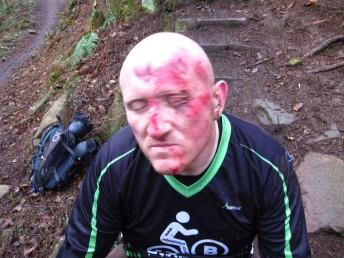 Cuts from mountain bike crash at Cwm Carn