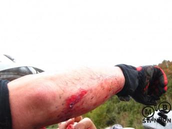 Deep cut from mountain biking crash.
